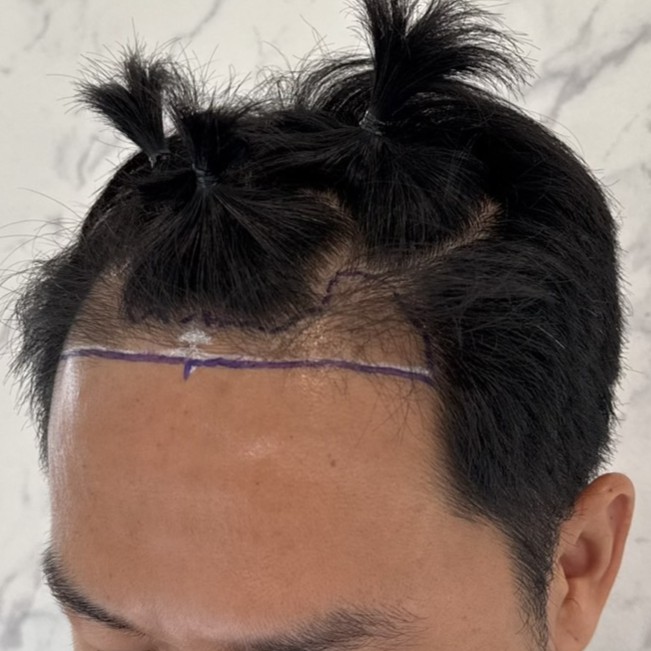 case23-khunch-02-surgery-day-1
