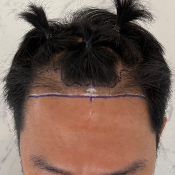 case23-khunch-02-surgery-day-2