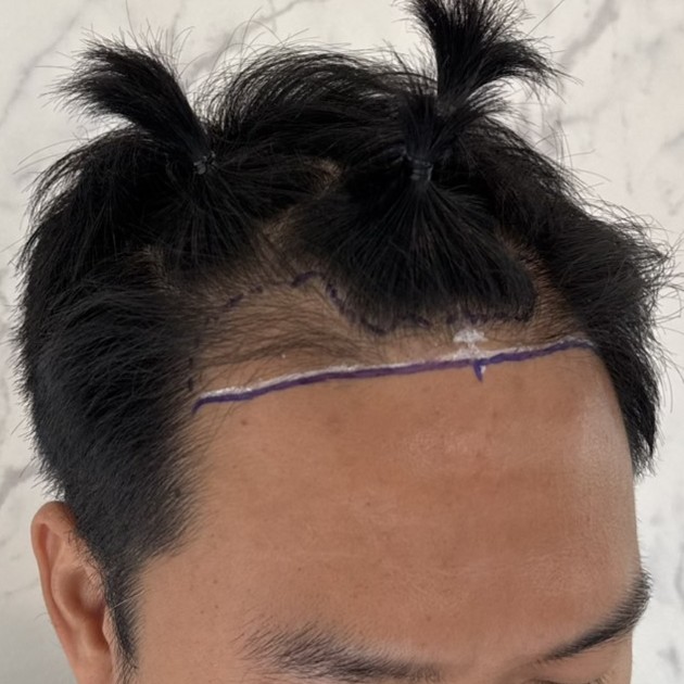 case23-khunch-02-surgery-day-3