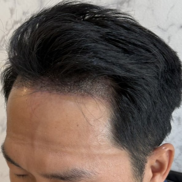 case23-khunch-03-after-immediate-1