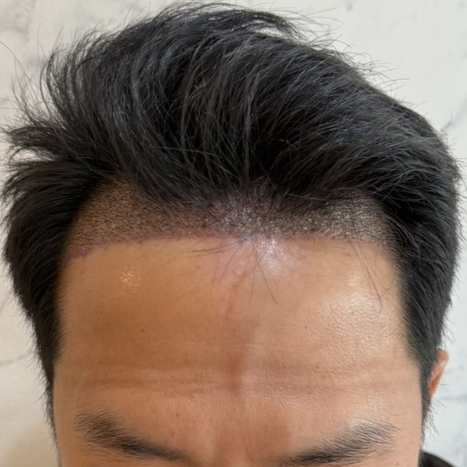 case23-khunch-03-after-immediate-2