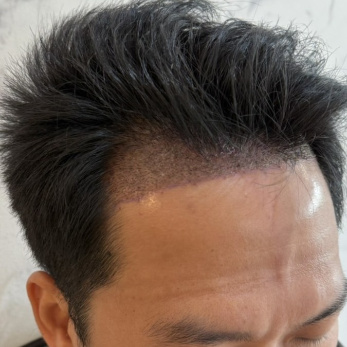 case23-khunch-03-after-immediate-3