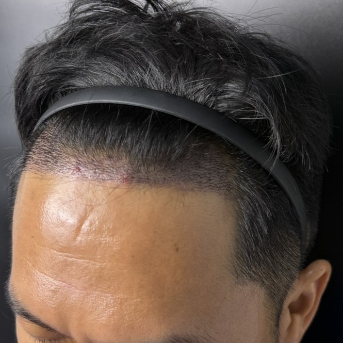 case23-khunch-04-after-14d-1