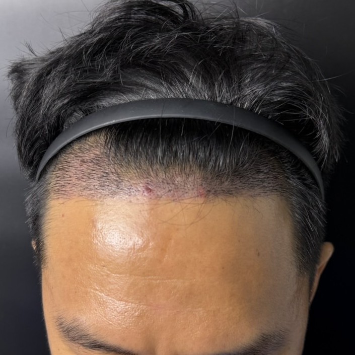 case23-khunch-04-after-14d-2