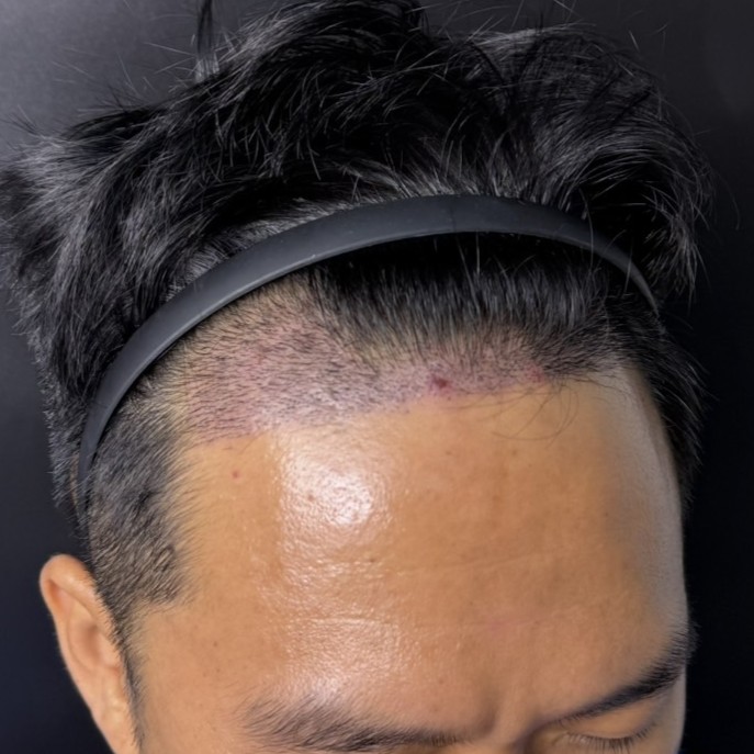 case23-khunch-04-after-14d-3
