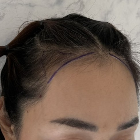 case24-khuntm-01-surgery-day-3