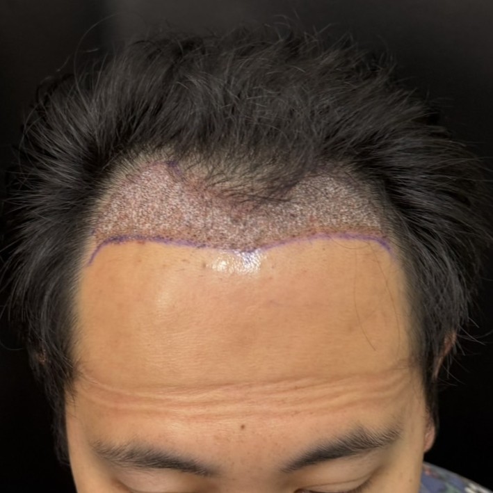 case28-khunan-02-after-immediate-1