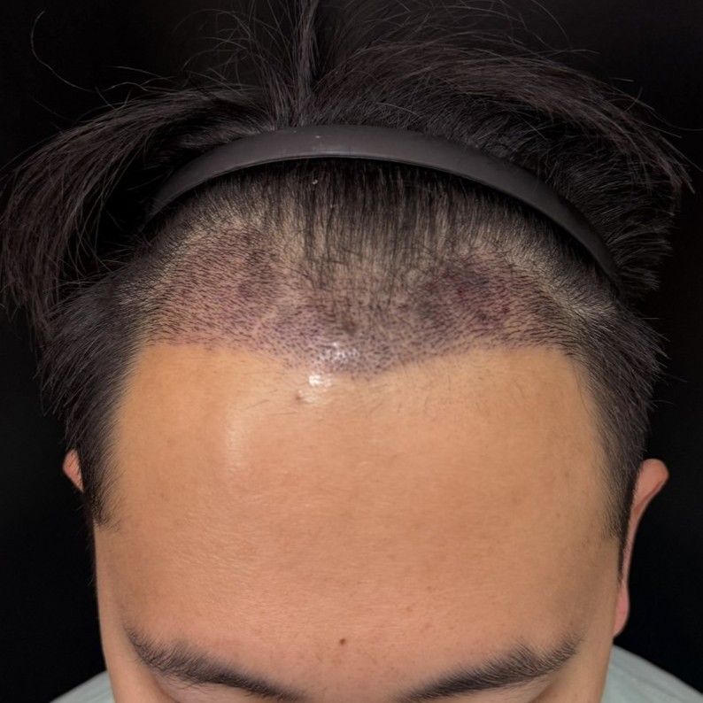 case28-khunan-03-after-14d-1