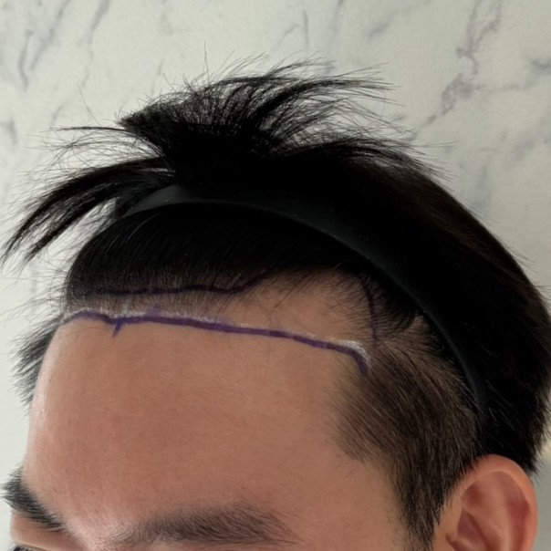 case29-khuntp-02-surgery-day-1