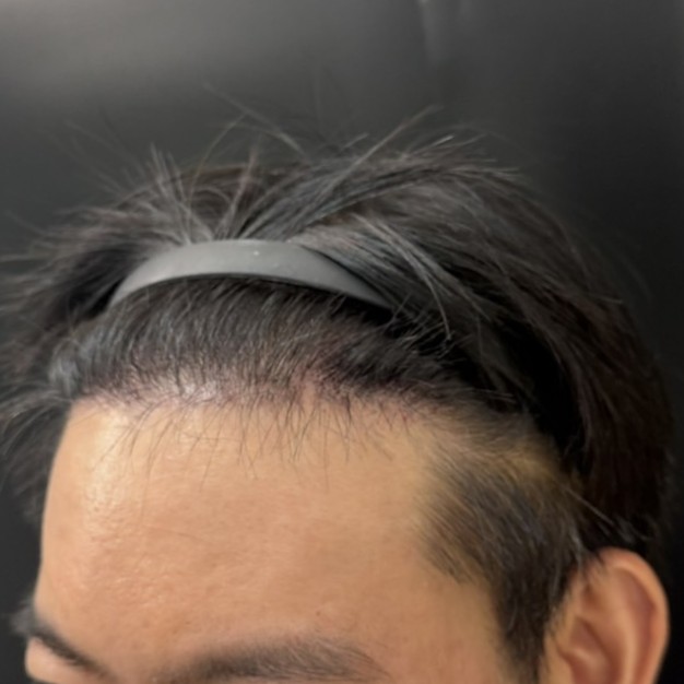 case29-khuntp-04-after-14d-1