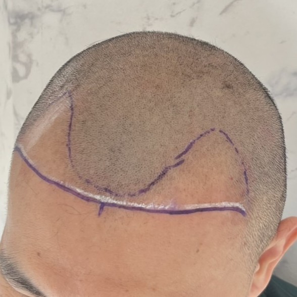 case30-khunx-02-surgery-day-1