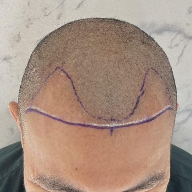 case30-khunx-02-surgery-day-2