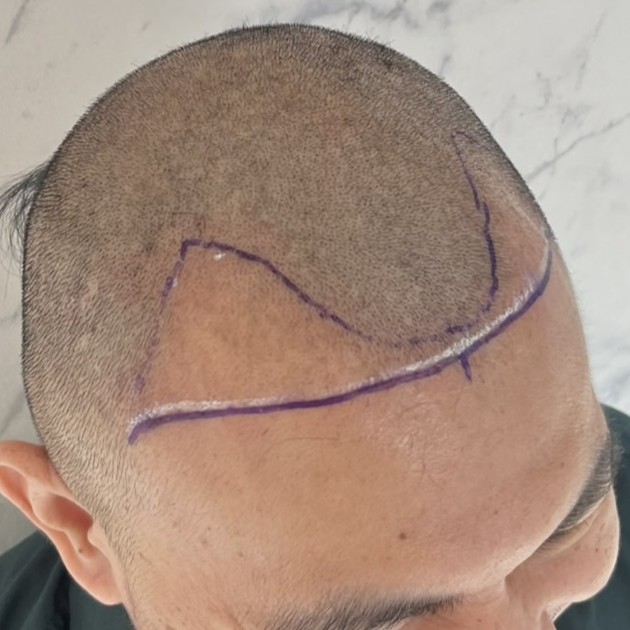 case30-khunx-02-surgery-day-3