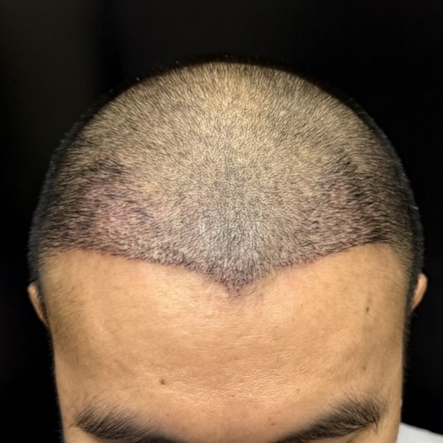 case30-khunx-04-after-14d-1