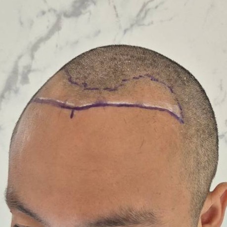 case31-khunth-02-surgery-day-1