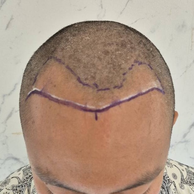 case31-khunth-02-surgery-day-2