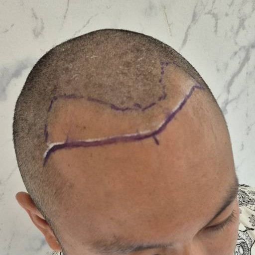 case31-khunth-02-surgery-day-3