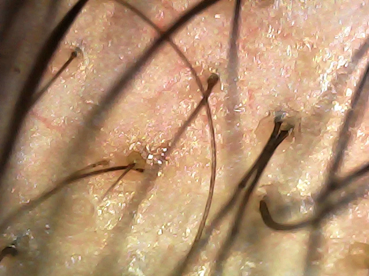ht-03-trichoscope-scalp