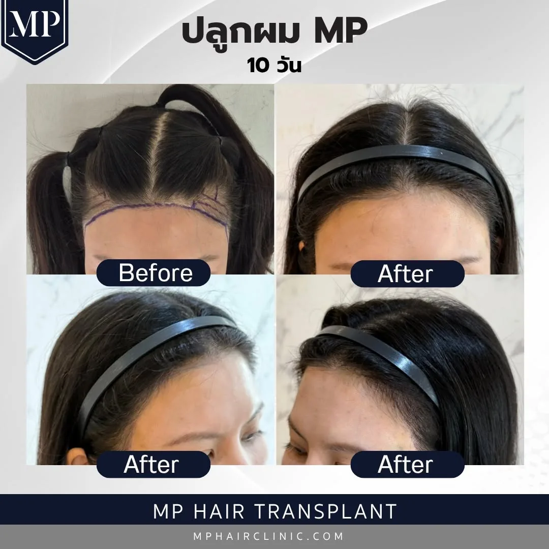 lh-02-before-after-10-days
