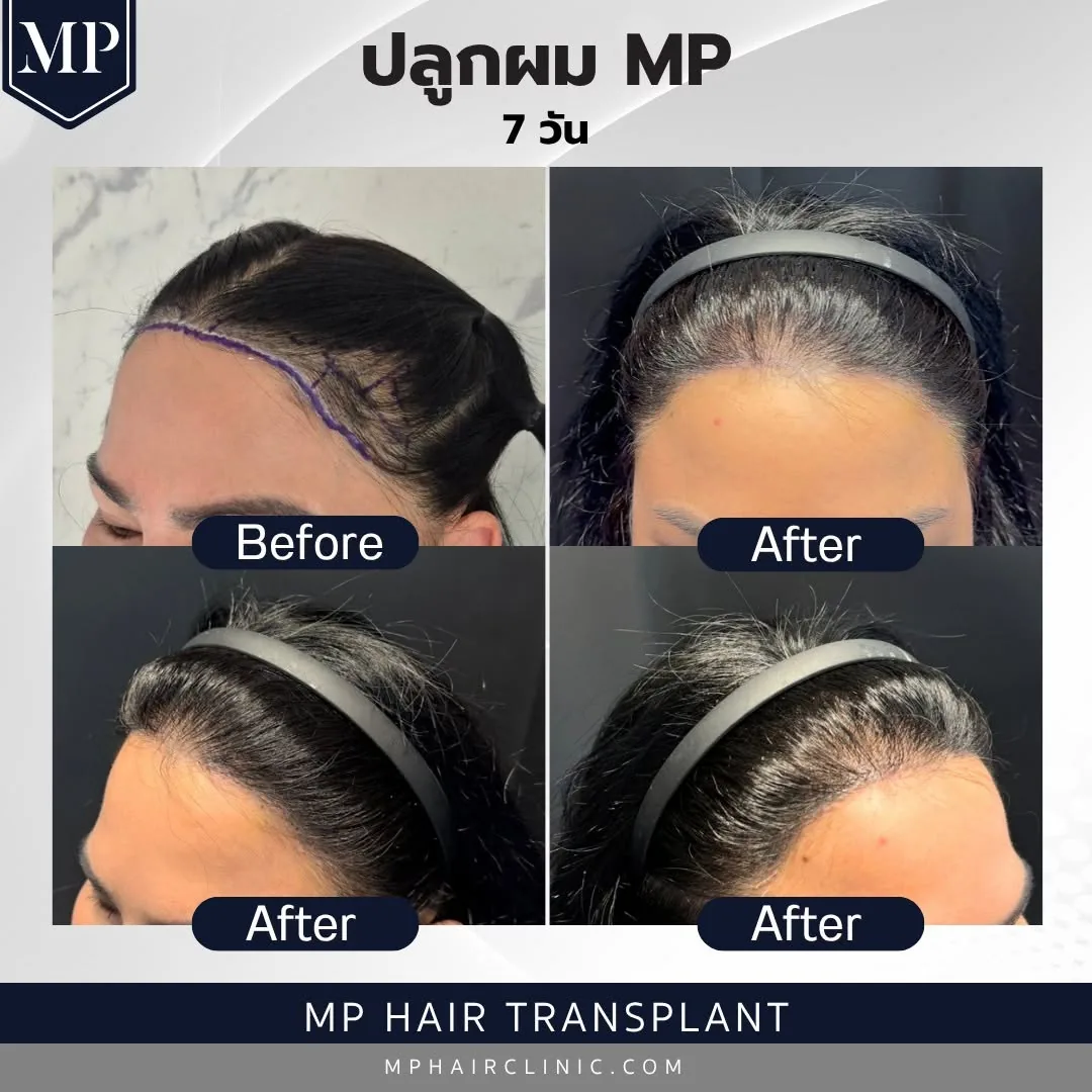 lh-03-before-after-7-days